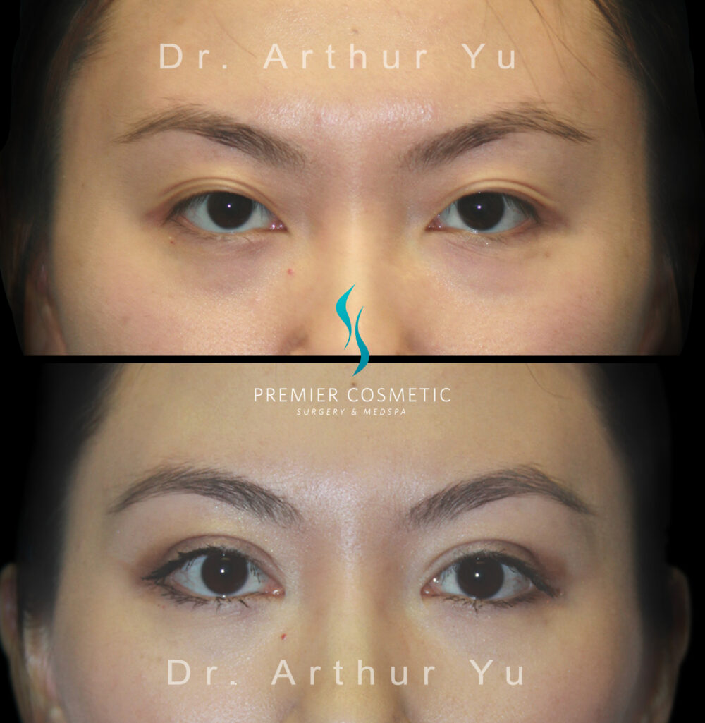 Upper Eyelid Surgery case #3146