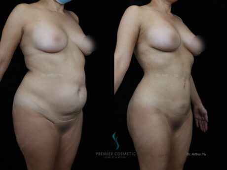 Liposuction case #2161