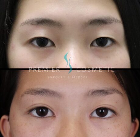 Upper Eyelid Surgery case #2434