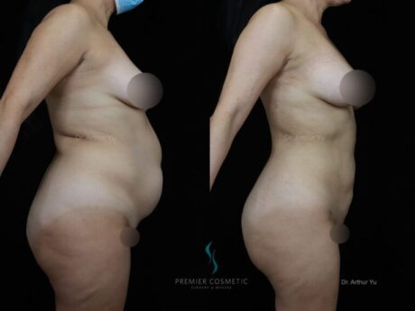 Liposuction case #18199