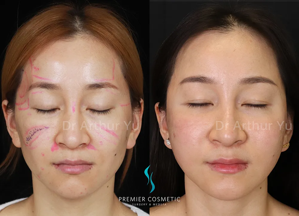 Sculptra case #17348