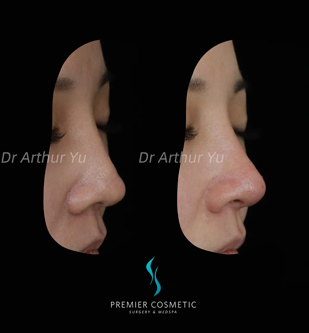 Art TipLyft® case #17339