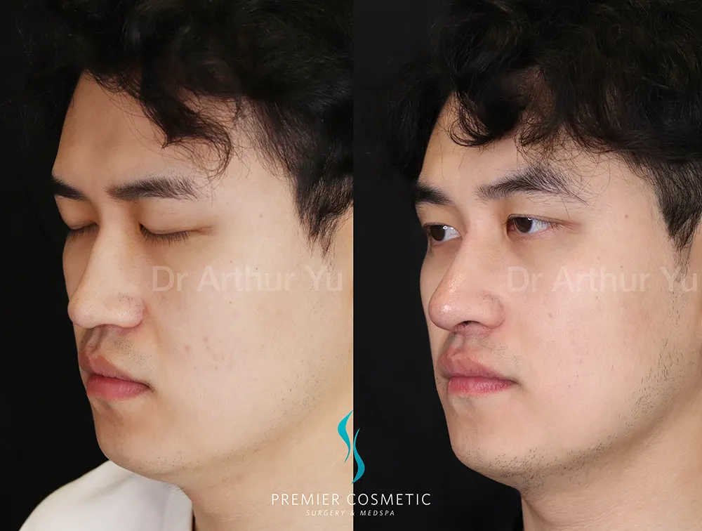 Art TipLyft® case #17275