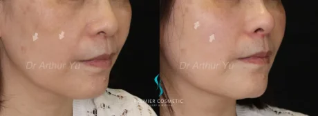 Dermal Filler case #17363