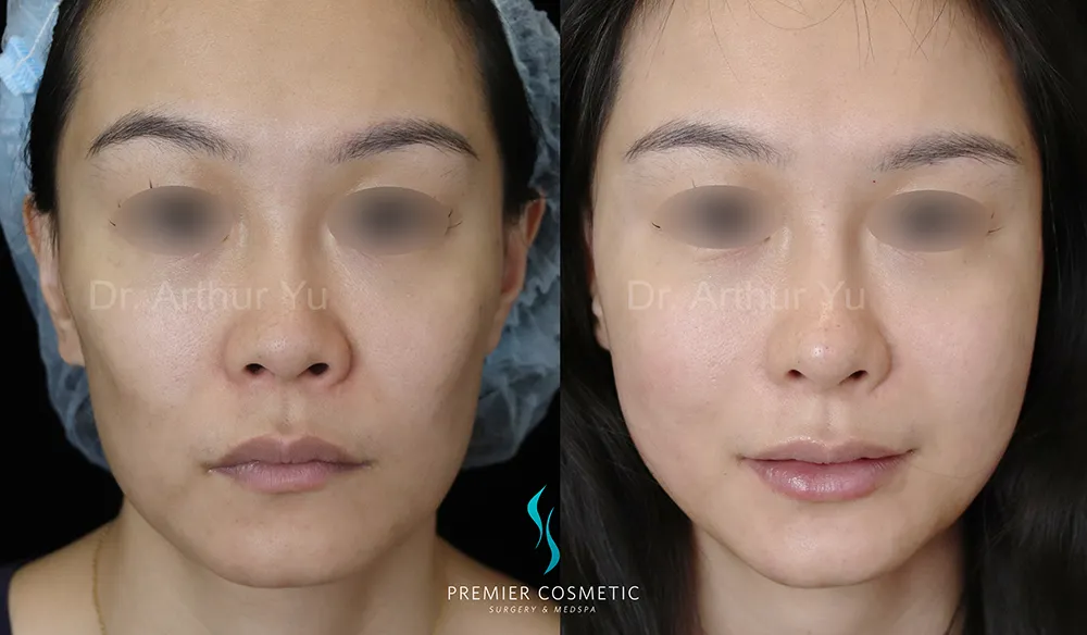Sculptra case #17353