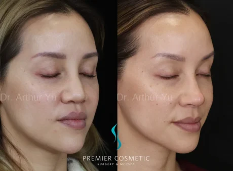 Art TipLyft® case #18277