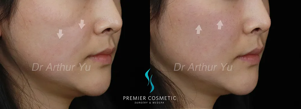 Dermal Filler case #17369