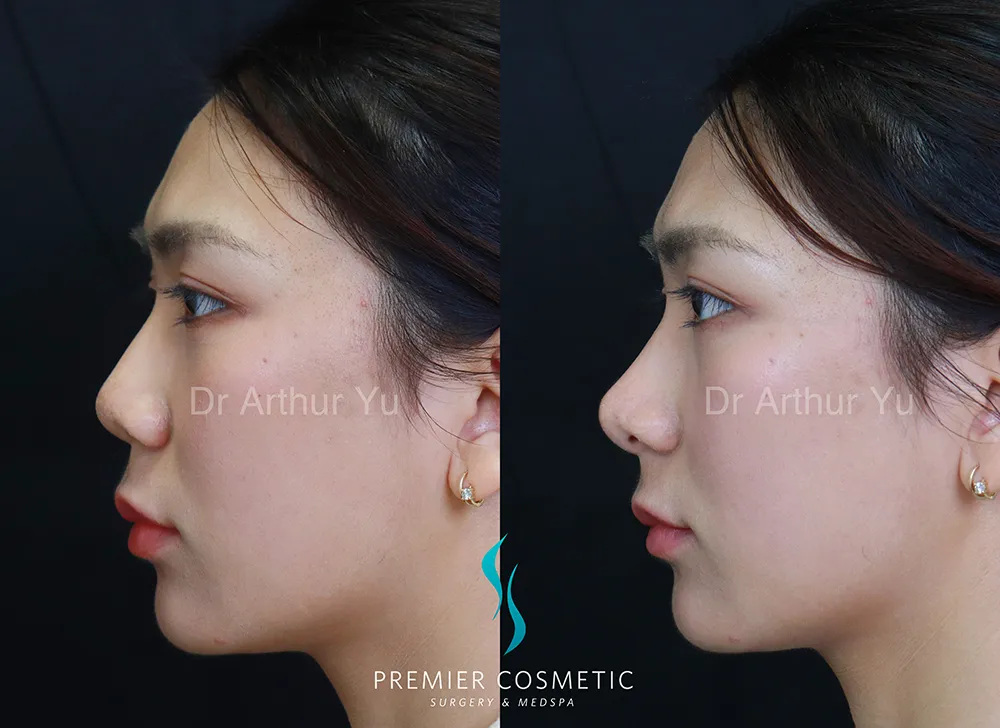 Art TipLyft® case #17291