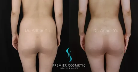 Butt Fat Grafting case #17375