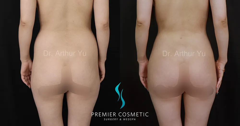 Butt Fat Grafting case #17375