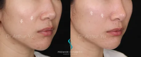 Dermal Filler case #17371