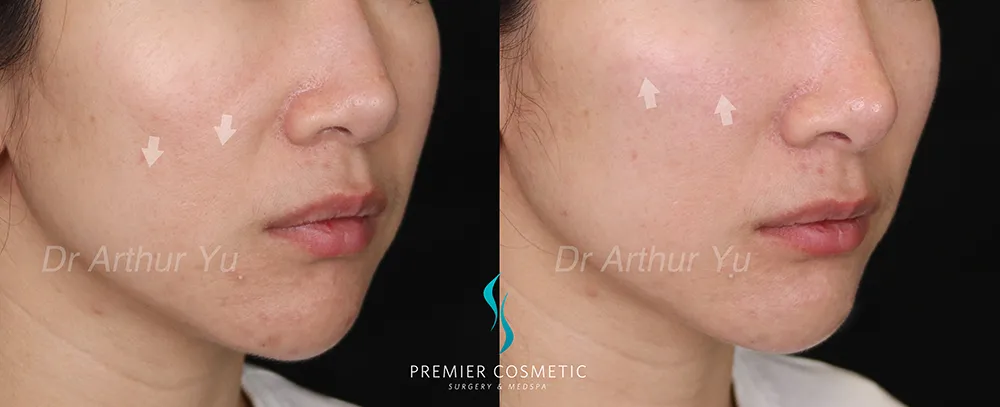 Dermal Filler case #17371