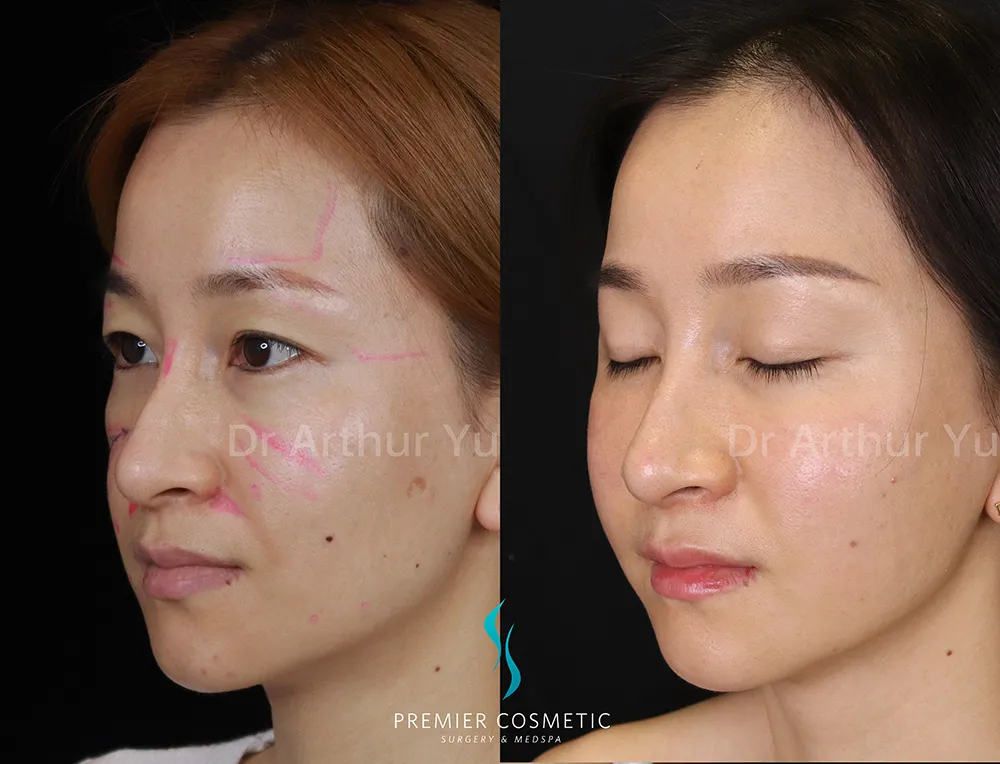 Full Face Fat Grafting case #17382