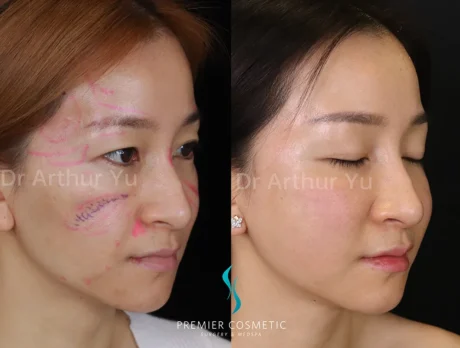 Full Face Fat Grafting case #17526