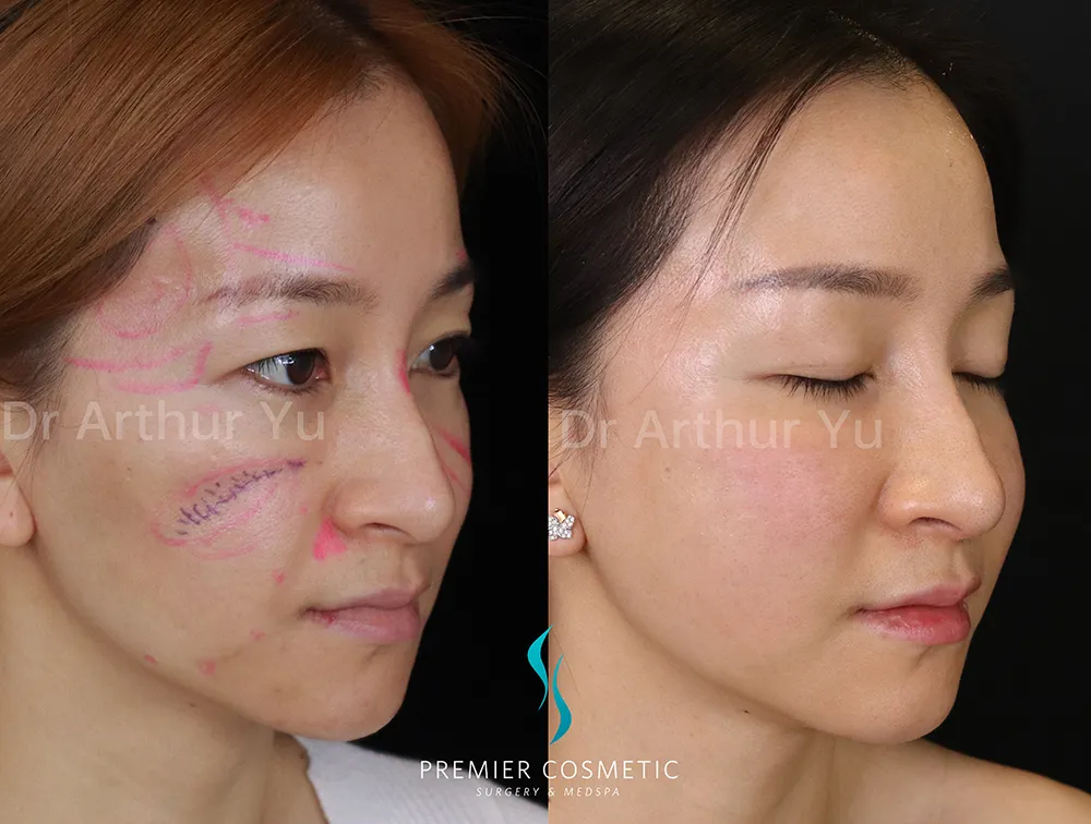 Full Face Fat Grafting case #17382