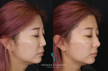 Art TipLyft® case #18268