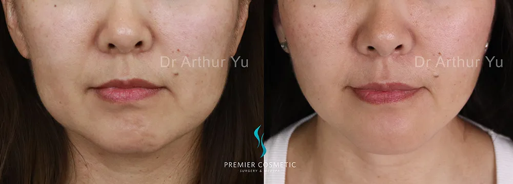 Buccal Fat Removal case #17399