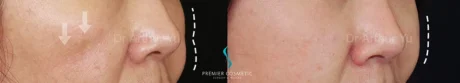 Dermal Filler case #17367
