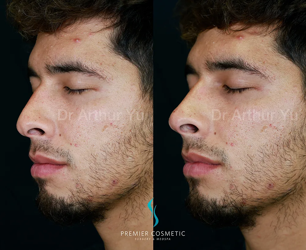 Art TipLyft® case #17343