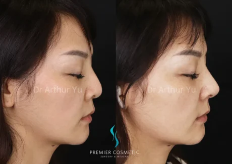 Art TipLyft® case #18274