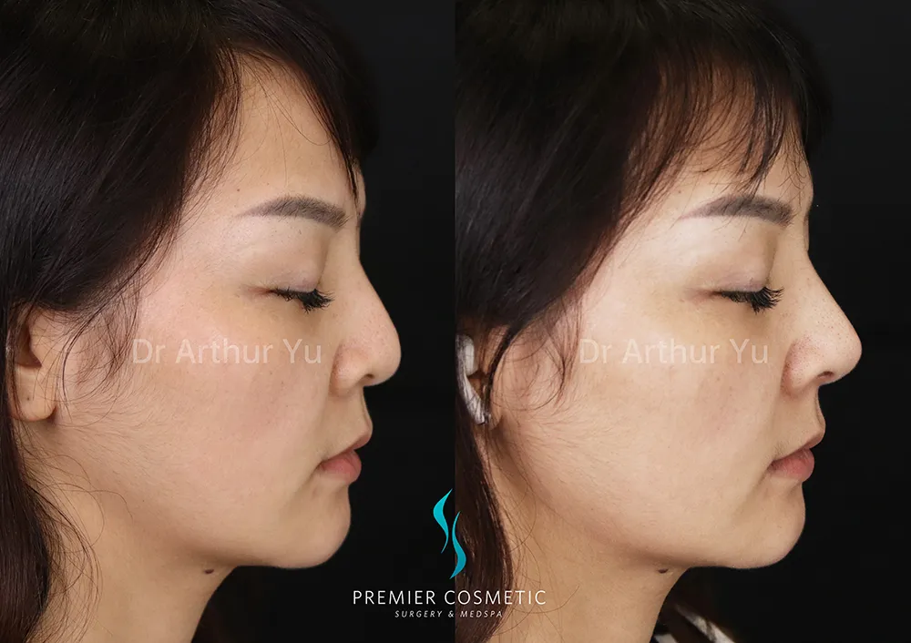 Art TipLyft® case #17289