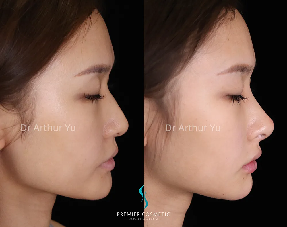 Art TipLyft® case #17301