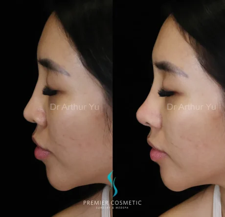 Art TipLyft® case #18275