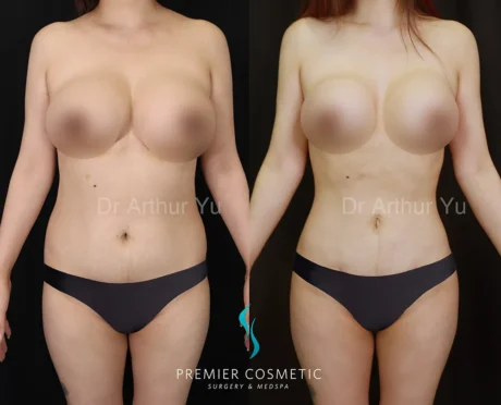 Liposculpture case #17345