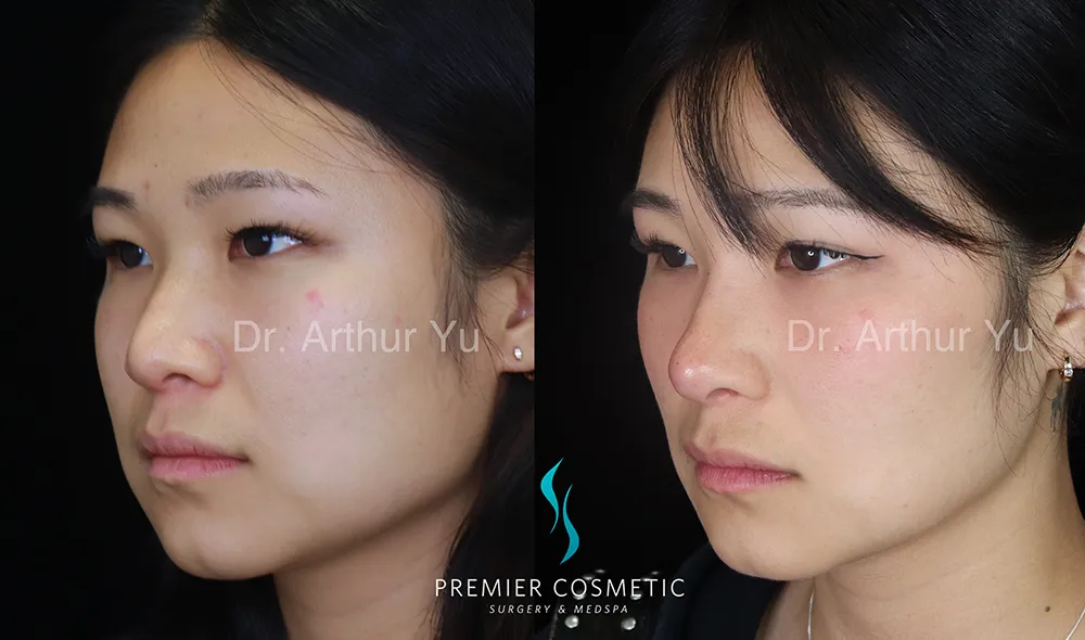 Art TipLyft® case #17315