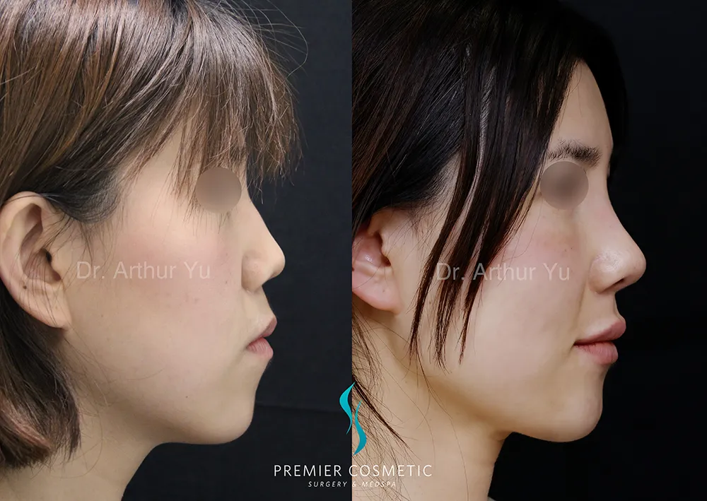 Art TipLyft® case #17293