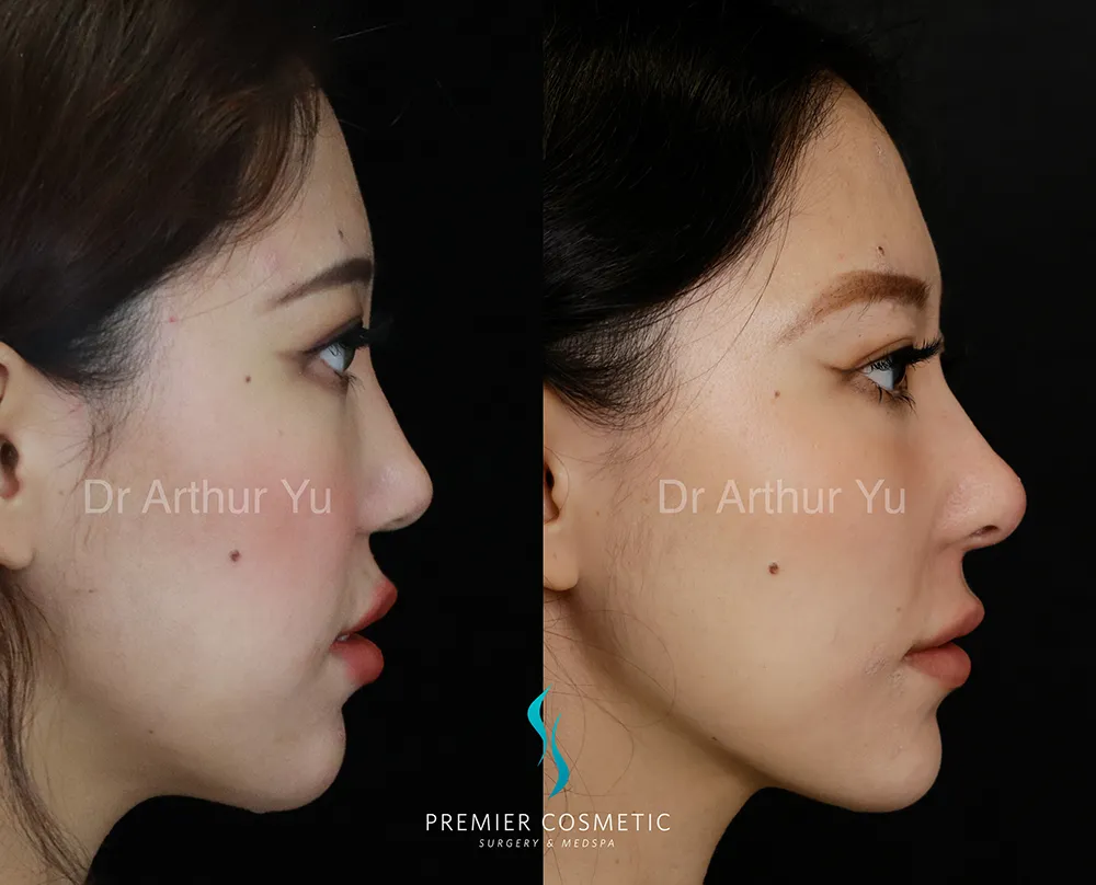 Art TipLyft® case #17279