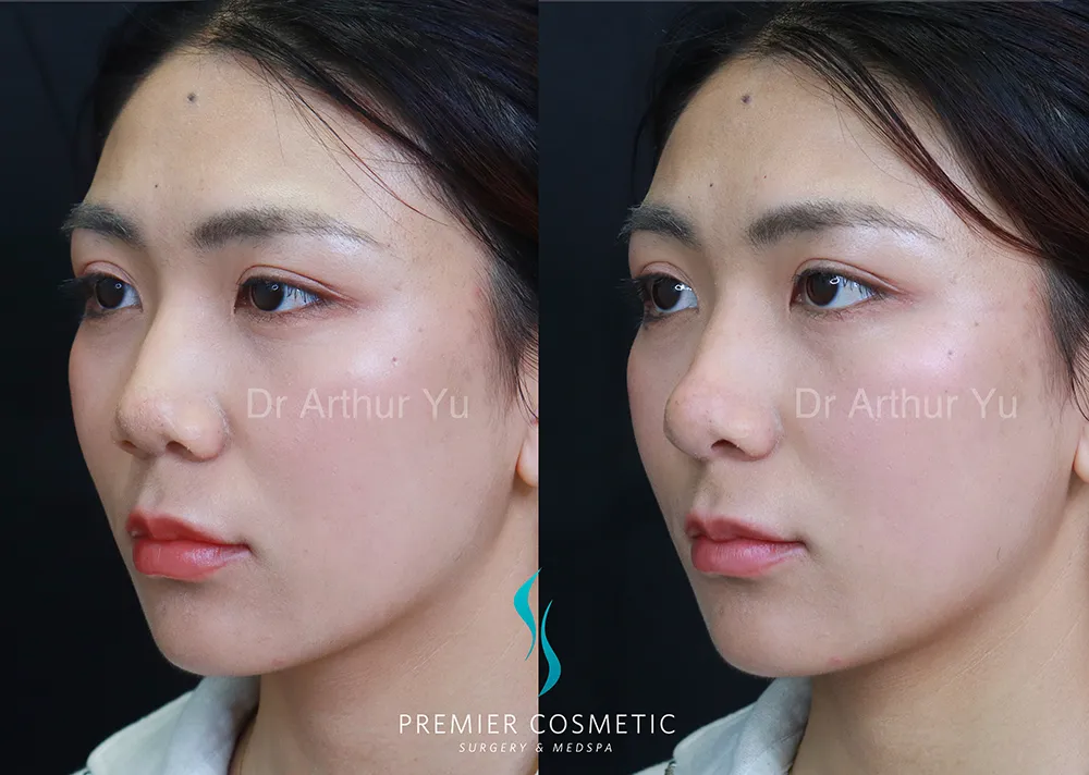 Art TipLyft® case #17291