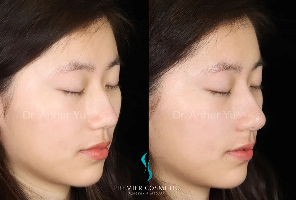 Art TipLyft® case #17313