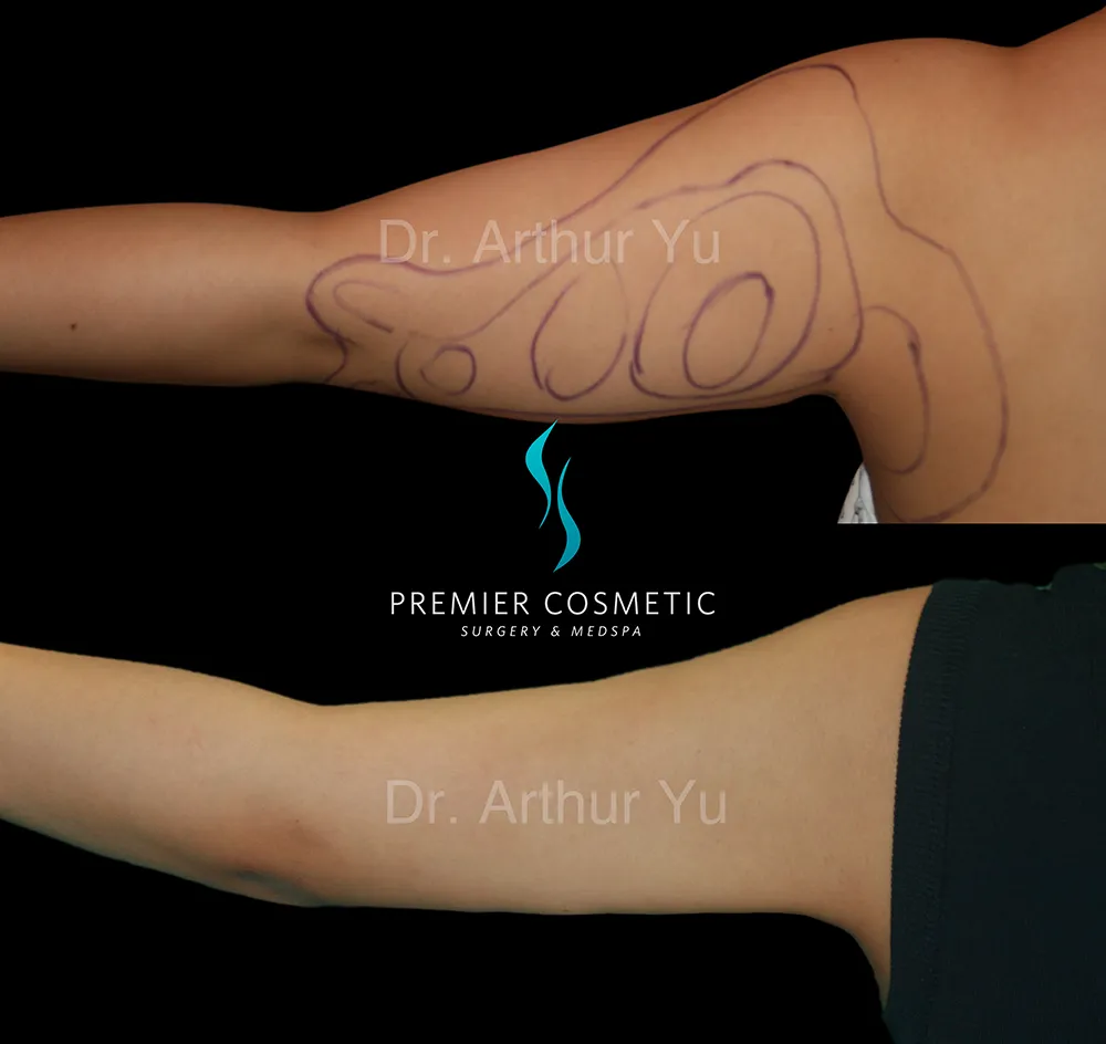 Arm Liposuction case #17430