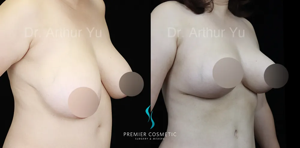 Breast Lift & Breast Reduction case #17416