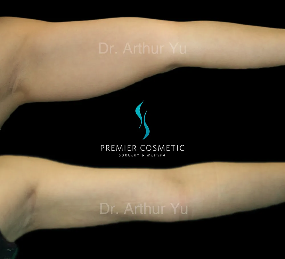 Arm Liposuction case #17432