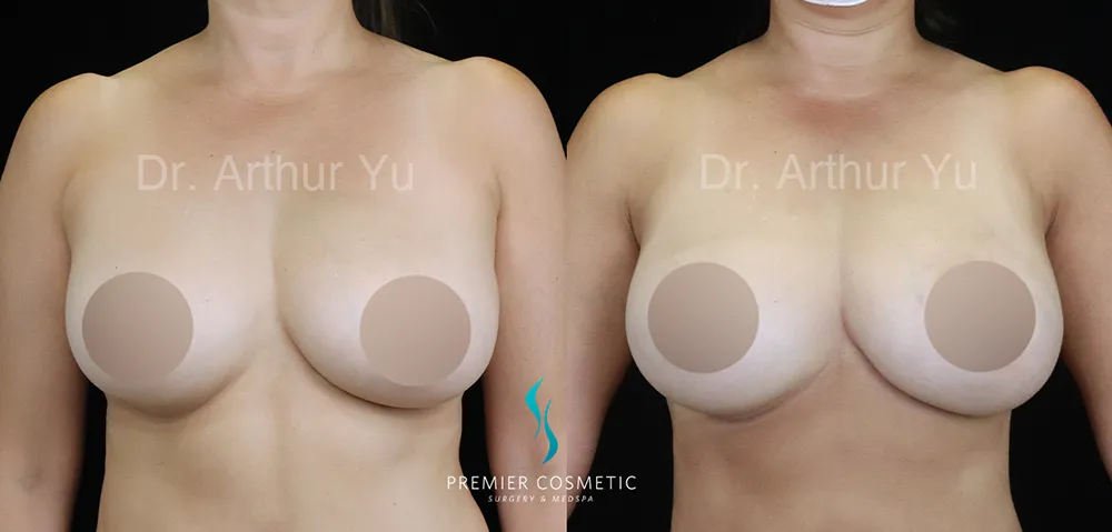Breast Lift & Breast Reduction case #17426