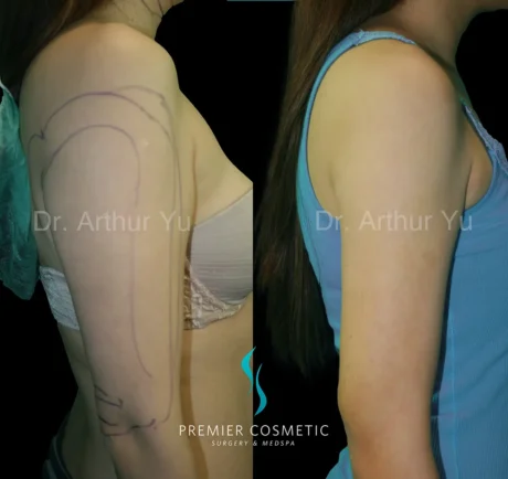 Arm Liposuction case #17386