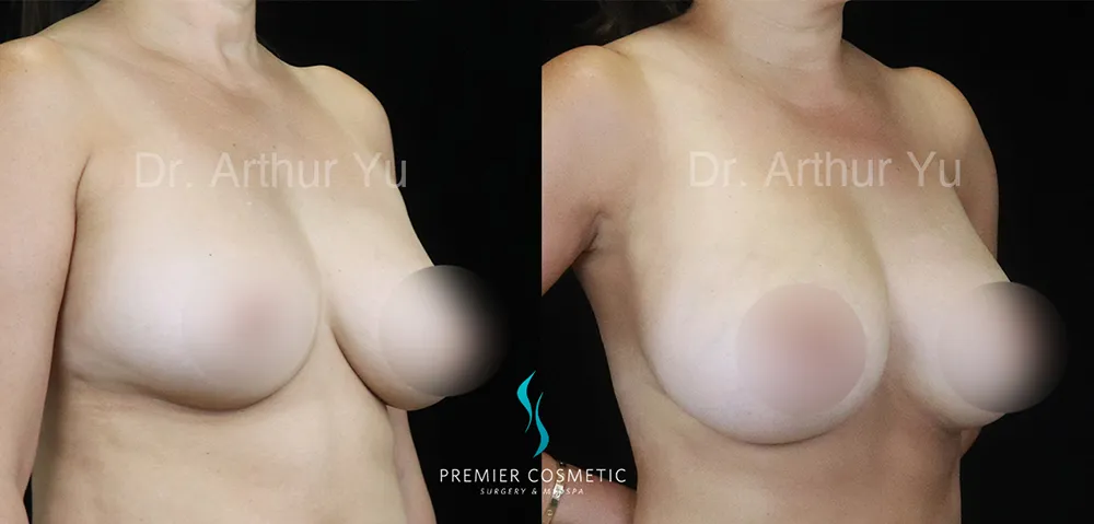 Breast Lift & Breast Reduction case #17422