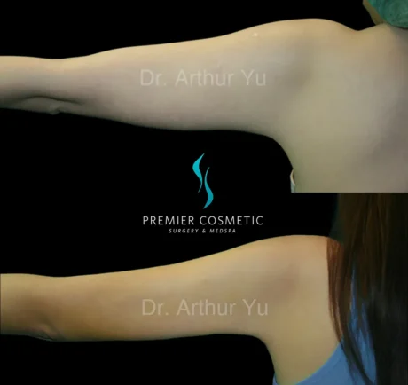 Arm Liposuction case #17433