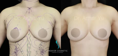 Breast Lift & Breast Reduction case #17418