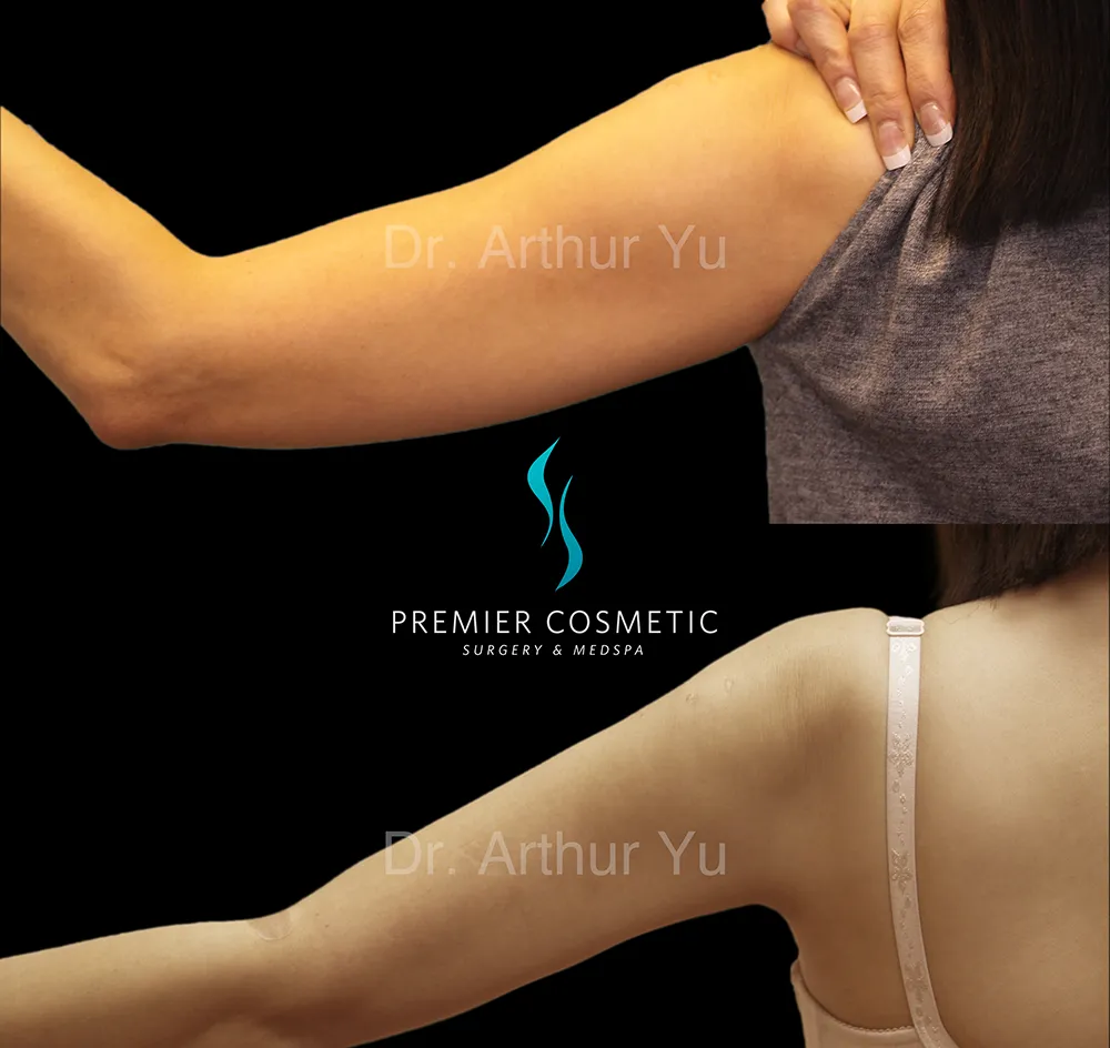 Arm Liposuction case #17392