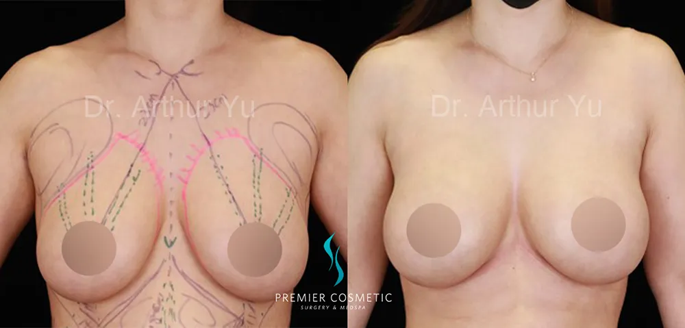 Breast Lift & Breast Reduction case #17420