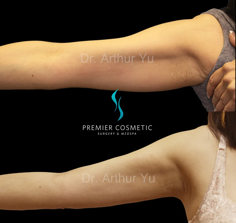 Arm Liposuction case #17429