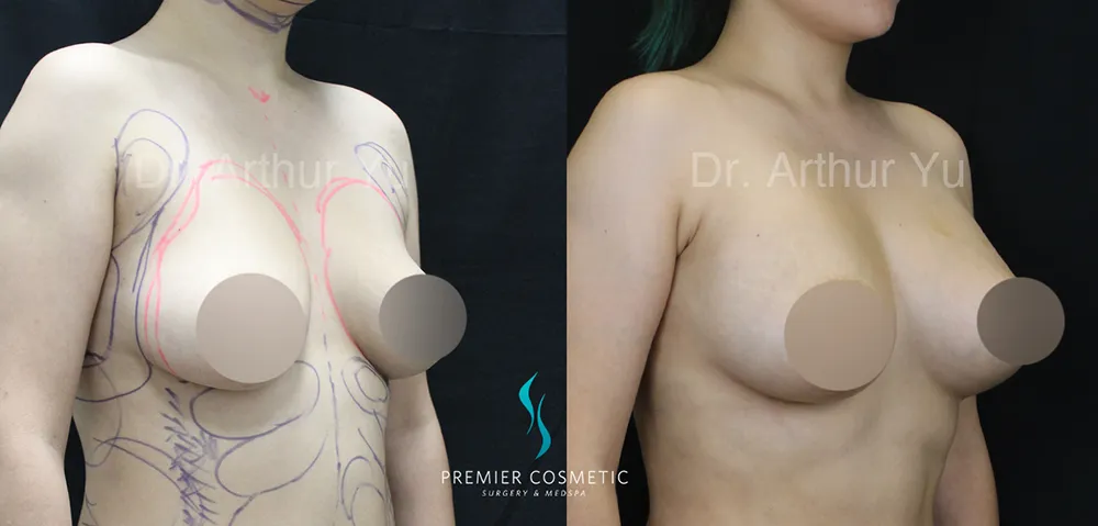 Breast Lift & Breast Reduction case #17424