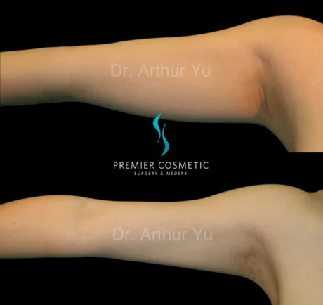 Arm Liposuction case #17428