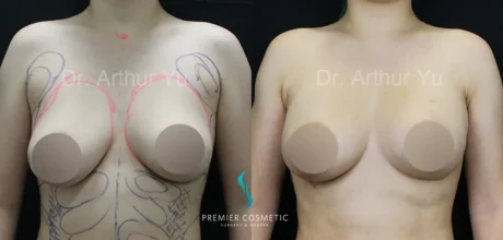 Breast Lift & Breast Reduction case #17412