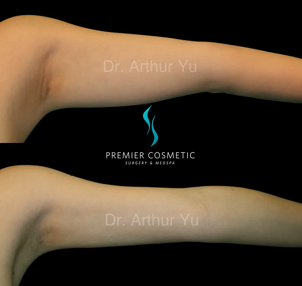 Arm Liposuction case #17396