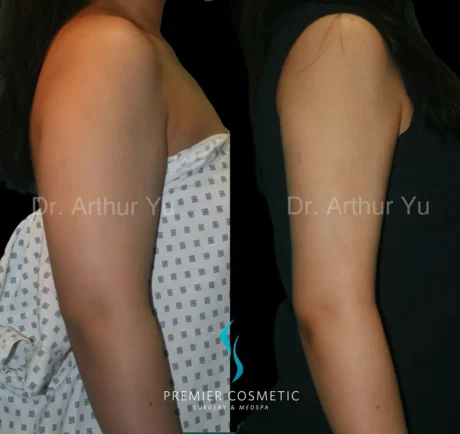 Arm Liposuction case #17389