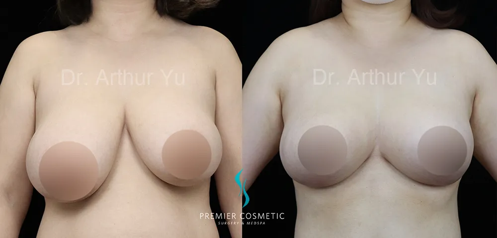 Breast Lift & Breast Reduction case #17414